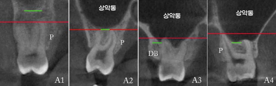 강남역어금니임플란트 치료 시 흔히 동반되는 상악동거상술 (Lateral window 방식), "잘 됐는지 어떻게 확인하죠?" 관련 이미지 4