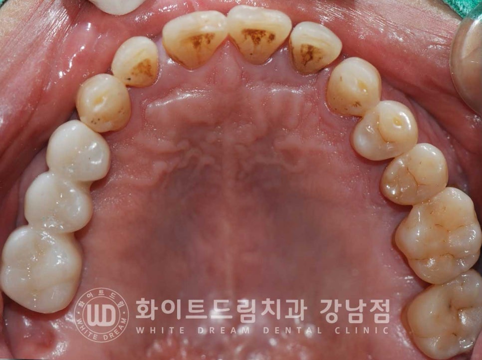 발치 즉시 임플란트 "내원 당일 발치 후 바로 임플란트 식립!" 관련 이미지 14