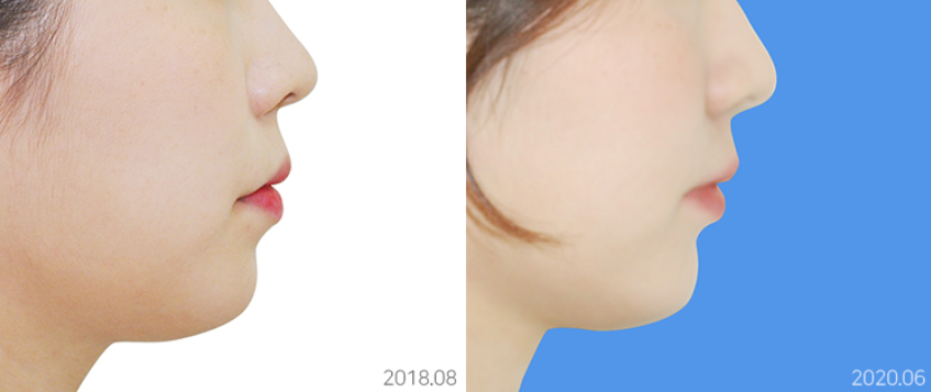 얼굴공개없는 치아교정 모델 모집 관련 이미지 11