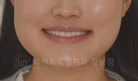 강남 벌어진앞니 교정 / "심하게 벌어진 치아, 어떻게?" 부분교정 + 라미네이트로 개선! 관련 이미지 6