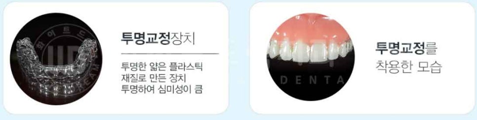 강남역 나비앞니 라미네이트 / "투명교정과 라미네이트 치료" 강남역 화이트드림치과 관련 이미지 5