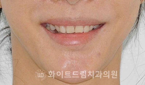 강남옹니라미네이트 "치아가 안으로 들어가서 할머니처럼 보여요" 경미 & 중증도 옹니 라미네이트 치료 관련 이미지 3