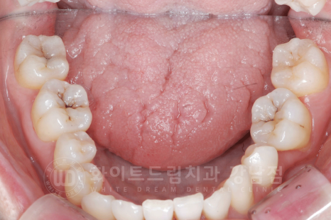 강남 덧니 비발치교정 / 임플란트와 치아교정 동시 진행 case 리뷰. 관련 이미지 18