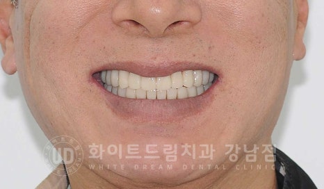 임플란트 재수술 잘하는치과 / 재수술과 전체 임플란트 치료를 동시에! 관련 이미지 13