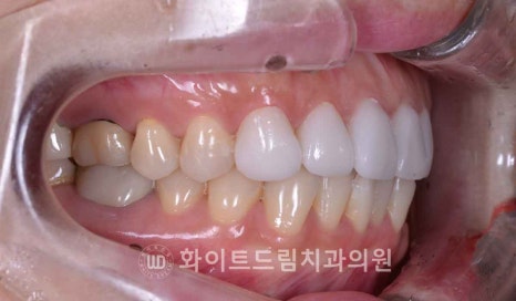뱅뱅사거리치과 "라미네이트가 마음에 들지 않아요. 하얗고 균일한 치아를 갖고 싶어요." 강남역 화이트드림치과 관련 이미지 13