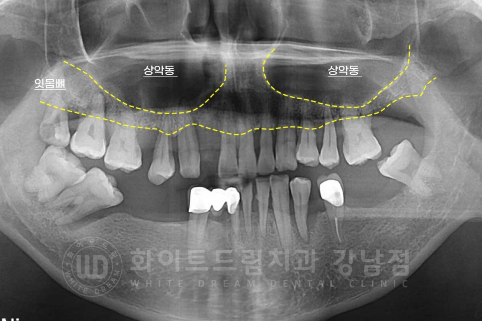 상악동거상술 잘하는치과, 강남역 화이트드림치과 상악동 함기화로 인한 거상술 치료 리뷰 관련 이미지 2