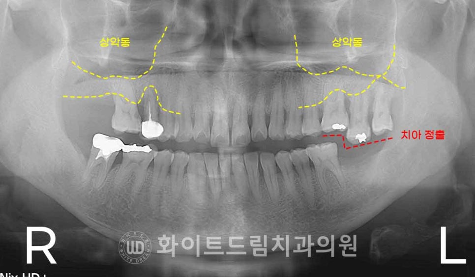 강남역치과 임플란트 "발치 후 바로 임플란트가 가능한 경우 vs 기다려야 하는 경우" 관련 이미지 4