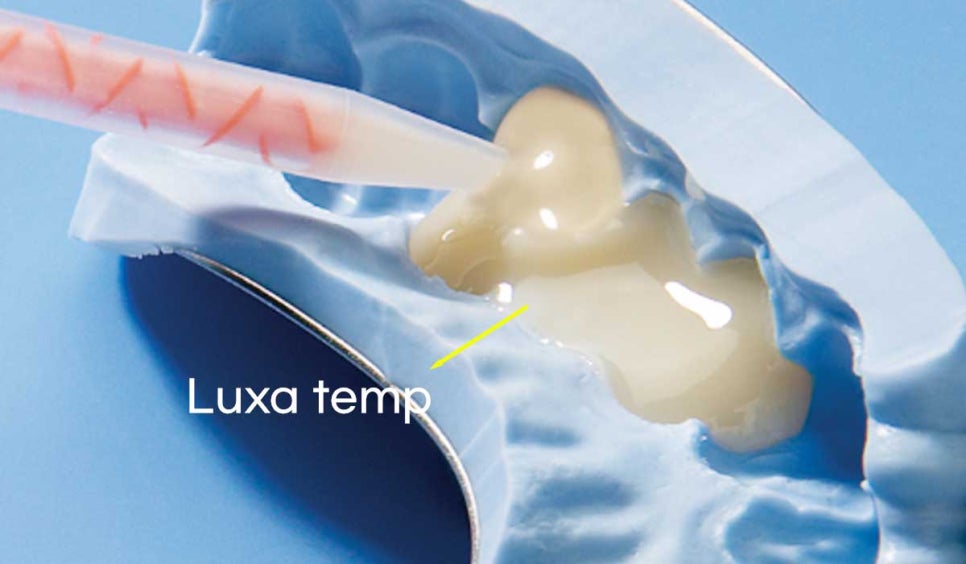 앞니 충치 라미네이트 치료 / "옆 크라운과 치아 색상을 맞추고 싶어요" 관련 이미지 9