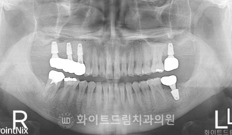 강남역치과 임플란트 "발치 후 바로 임플란트가 가능한 경우 vs 기다려야 하는 경우" 관련 이미지 11