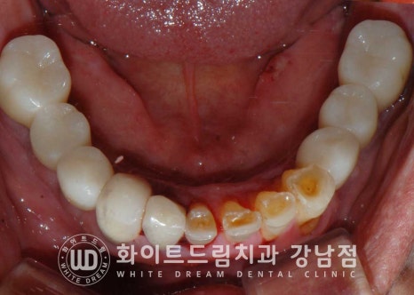 임플란트 개수를 줄일 수 있는 방법? (+치아를 발치한지 오래되었나요?) 관련 이미지 13