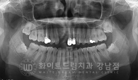 앞니 임플란트 사례 "예전에 심은 임플란트를 뺐어요. 재수술 가능할까요?" 관련 이미지 14