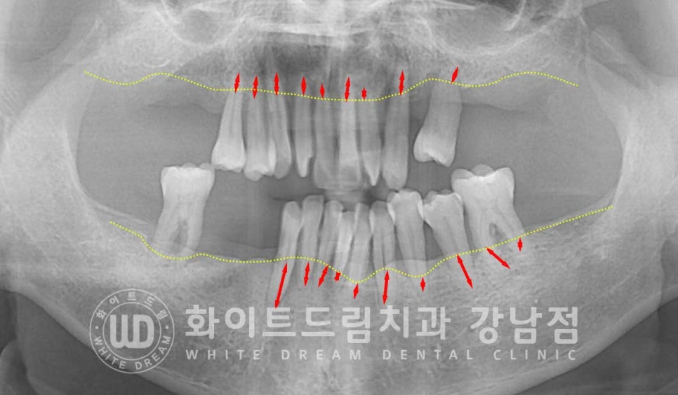 강남역 전악임플란트치과 / 치주 질환이 치아와 임플란트에 끼치는 영향! 관련 이미지 7