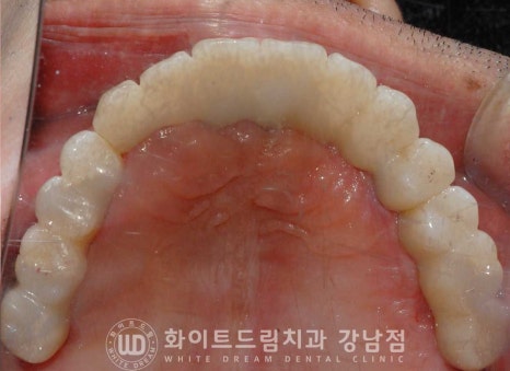 치주염 전체임플란트, 염증으로 인한 상악동 천공 & 신경관 가까이 녹은 잇몸뼈. 임플란트 식립 가능할까? 관련 이미지 17