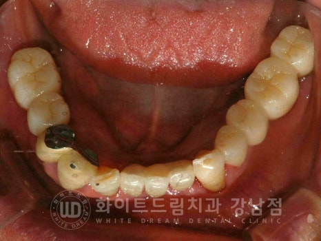 잇몸뼈가 없다는 게 무슨 말일까? "틀니를 오래 사용해서 잇몸뼈가 없대요" 임플란트 잘하는 강남치과 관련 이미지 12