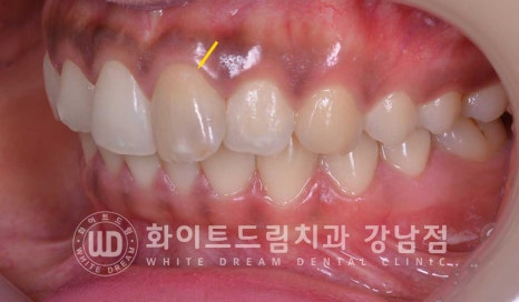 신경치료 후 변색된치아, 라미네이트로 변색과 모양까지 개선! / 강남역화이트드림치과 관련 이미지 2