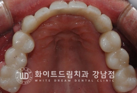 40대 전체임플란트 / 디지털스캔바디를 이용한 전체 임플란트 치료 사례 (Feat. 치주염) 관련 이미지 20
