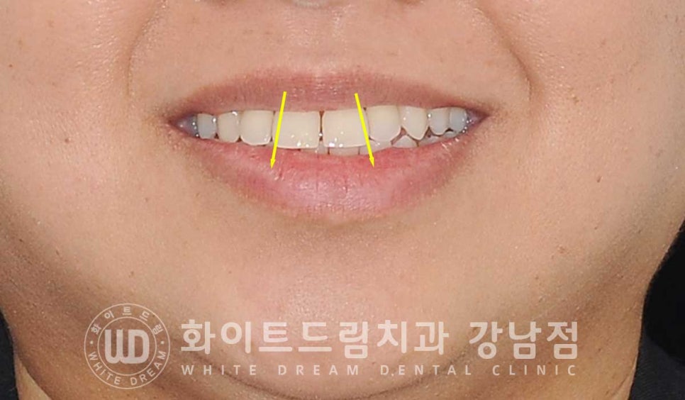 앞니 뻐드러짐 라미네이트 "뻐드러지고 벌어진 앞니" 당일 라미네이트 치료 case 관련 이미지 9