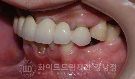 치주염 전체임플란트 치료 사례 / 치아를 흔들리게 만드는 치주염이란? 관련 이미지 17