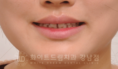 강남 벌어진앞니 교정 / "심하게 벌어진 치아, 어떻게?" 부분교정 + 라미네이트로 개선! 관련 이미지 14