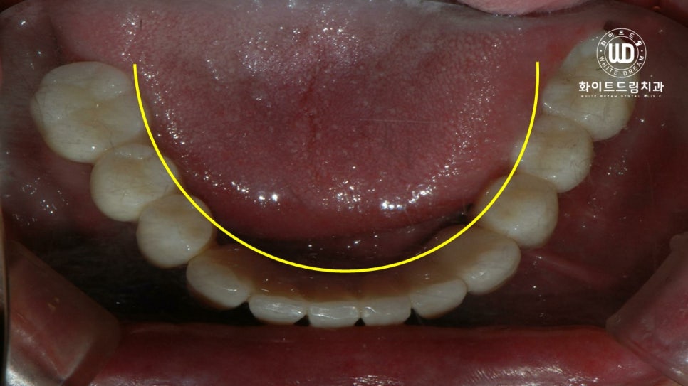 무너진 잇몸뼈와 치아 상실을 대체하는 전악임플란트 치료 사례 관련 이미지 12
