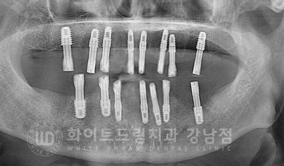 전체 임플란트 치료 기간과 내원 횟수는? "치과에 자주 가기 어려워요." 관련 이미지 20