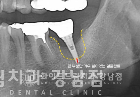 강남역 임플란트재수술 치과 / "임플란트가 흔들려요!" 임플란트 주위염 관련 이미지 6