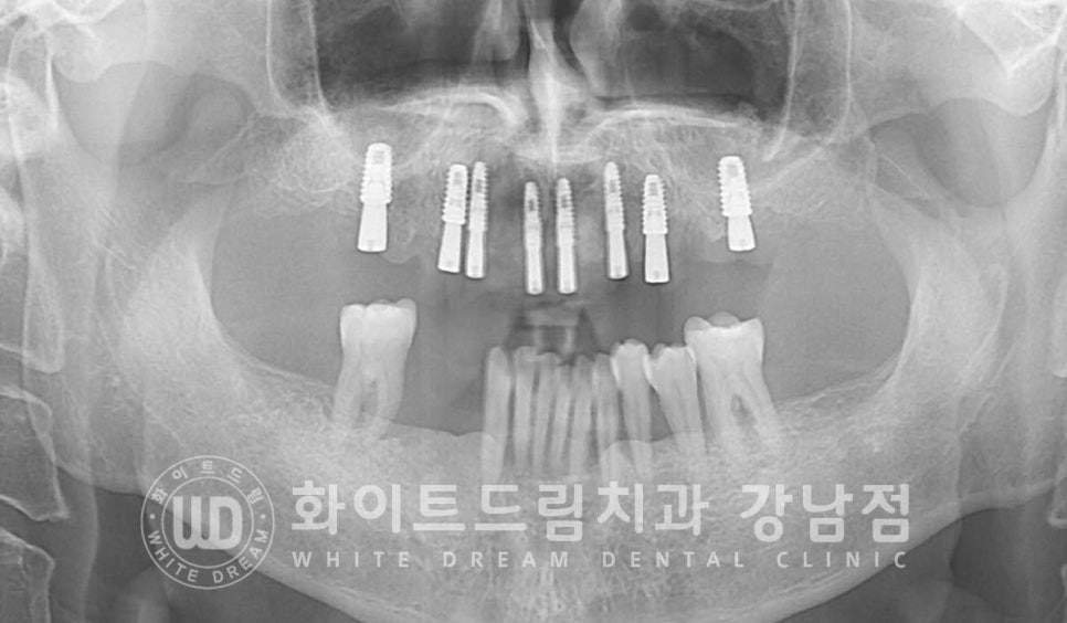 강남역 전악임플란트치과 / 치주 질환이 치아와 임플란트에 끼치는 영향! 관련 이미지 10