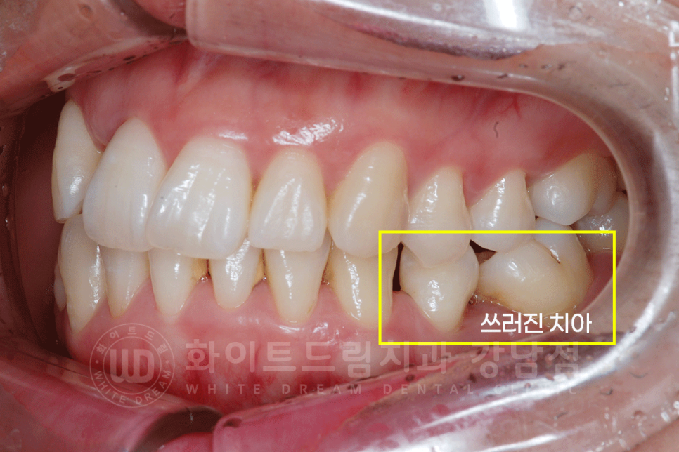강남 덧니 비발치교정 / 임플란트와 치아교정 동시 진행 case 리뷰. 관련 이미지 8