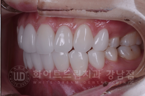 강남역 원데이 라미네이트 "유튜브 촬영하는데 치아가 신경 쓰여요" #강남화이트드림치과 관련 이미지 10