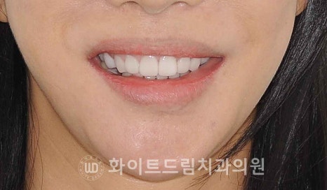 강남옹니라미네이트 "치아가 안으로 들어가서 할머니처럼 보여요" 경미 & 중증도 옹니 라미네이트 치료 관련 이미지 4