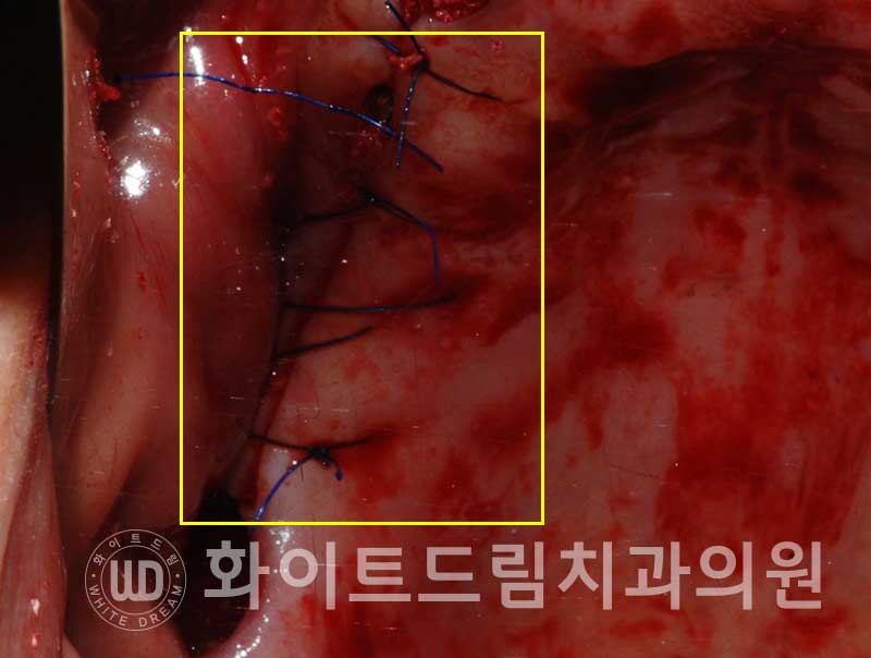 강남역전체임플란트 / 발치 후 즉시 식립, 무조건 누구나 3개월로 끝낼 수 있는 것일까? 강남역화이트드림치과 관련 이미지 13