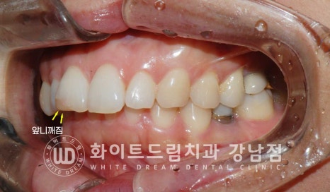 앞니 원데이라미네이트, 뻐드러지고 벌어진 앞니! 당일 치료 ok 관련 이미지 8