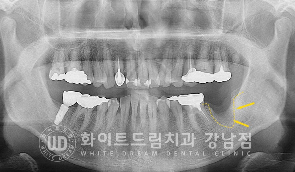 강남역 임플란트재수술 치과 / "임플란트가 흔들려요!" 임플란트 주위염 관련 이미지 8