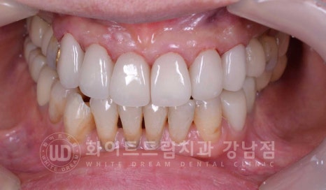 노화된 치아 라미네이트 / 치아미백을 해도 하얘지지 않는 마모된 치아는 어떻게 할까? 관련 이미지 14