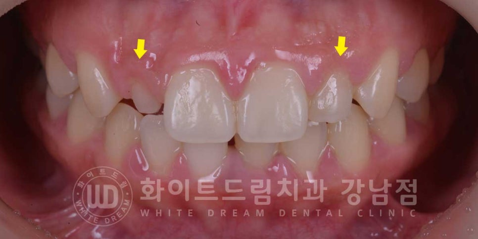 역삼역 왜소치치료 / 치아 하나가 너무 작아요. 왜소치 라미네이트 잘하는 치과 관련 이미지 3