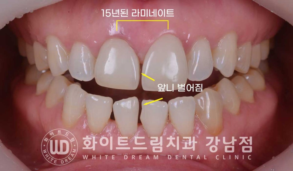 벌어진 앞니 라미네이트 / 50대 시니어 라미네이트 치료 사례 관련 이미지 4