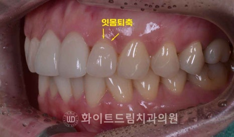 뱅뱅사거리치과 "라미네이트가 마음에 들지 않아요. 하얗고 균일한 치아를 갖고 싶어요." 강남역 화이트드림치과 관련 이미지 5