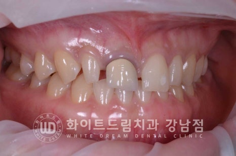 벌어진 앞니라미네이트 / "왜소치로 치아가 벌어졌어요" 치료 사례 관련 이미지 8
