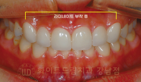 강남 벌어진앞니 교정 / "심하게 벌어진 치아, 어떻게?" 부분교정 + 라미네이트로 개선! 관련 이미지 13