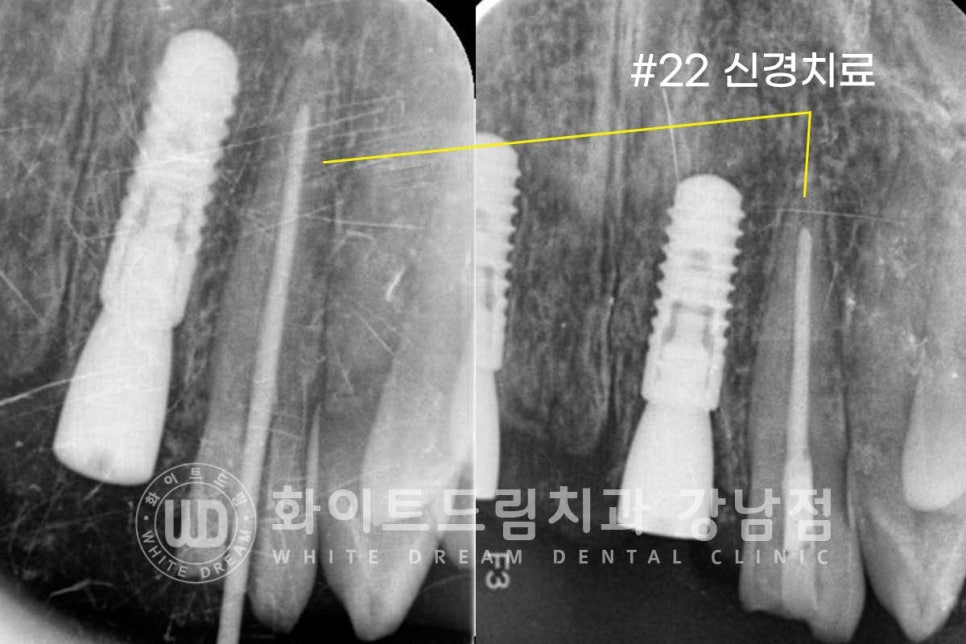 앞니 빠짐 임플란트 / 사고로 인한 앞니 탈구. 앞니 임플란트 치료는? 관련 이미지 9
