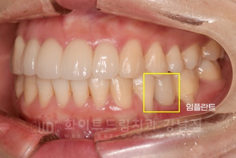 강남 덧니 비발치교정 / 임플란트와 치아교정 동시 진행 case 리뷰. 관련 이미지 17