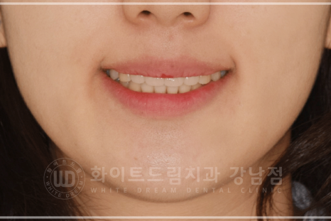 강남 덧니 비발치교정 / 임플란트와 치아교정 동시 진행 case 리뷰. 관련 이미지 29