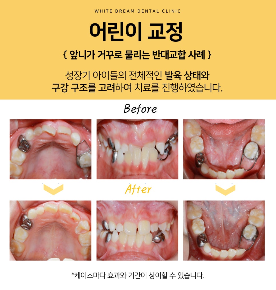 치아교정, 꼭 해야 한다면 미리 알아 두자. 관련 이미지 12