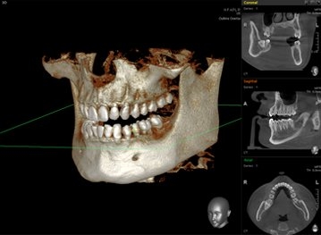 임플란트 하기 전 알아보아야 할 것. 관련 이미지 26