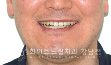 강남역 결손치 "앞니 두 개가 없고, 벌어졌어요" 결손치 치료 방법 관련 이미지 14