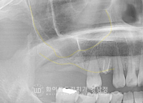 신경치료 후 크라운을 해야 하는 이유 / 크라운을 안 해 부러진 치아 임플란트 치료 case 관련 이미지 14
