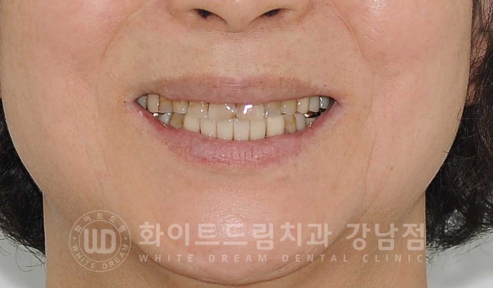 중년 앞니라미네이트 / 노화로 마모되고 누렇게 변한 치아, 어떻게 치료할까? 관련 이미지 1