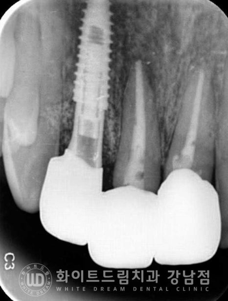 사고당한 앞니치료, "흔들리고 점점 변색돼요." 앞니 임플란트 & 신경치료 관련 이미지 8