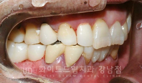 잇몸뼈가 없다는 게 무슨 말일까? "틀니를 오래 사용해서 잇몸뼈가 없대요" 임플란트 잘하는 강남치과 관련 이미지 16