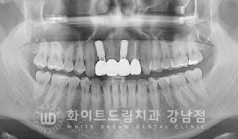앞니 빠짐 임플란트 / 사고로 인한 앞니 탈구. 앞니 임플란트 치료는? 관련 이미지 11